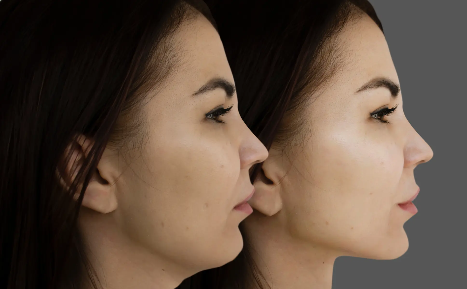 Kybella for Double Chin | The Natural Aesthetics and Wellness in Houston, TX